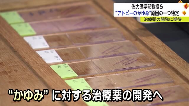 アトピー性皮膚炎の治療薬開発に期待 佐大医学部が"かゆみ"の原因のひとつを突き止める 【佐賀県】